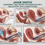 dilation and curettage